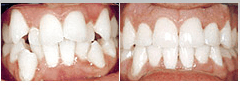 Dental braces completed in 4 months isle of man