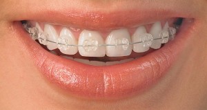 Demon Braces