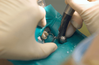 endodontics theraphy