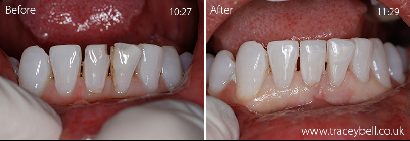 beforeafterW-VAP2C