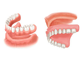 blogdenture1