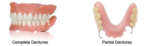 denture-partial2