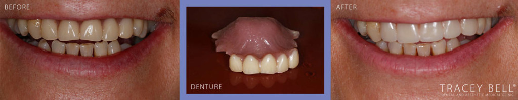 elaineprincedenturebeforeafter-denture