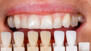 Dental Veneers 300x168