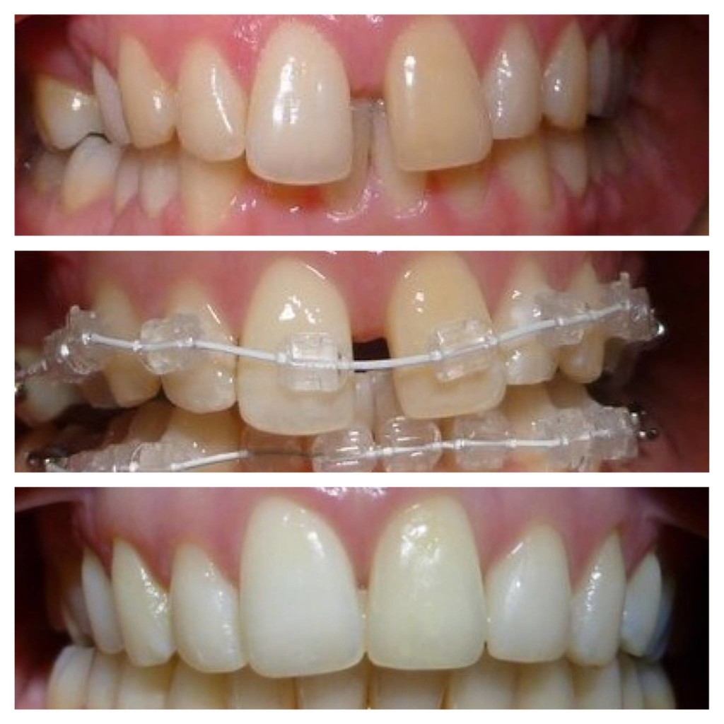 dental-brace-liverpool-tracey-bell-dental-1024x1024.jpg