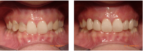 digital-smile-design-dentistry-traceybell-liverpool