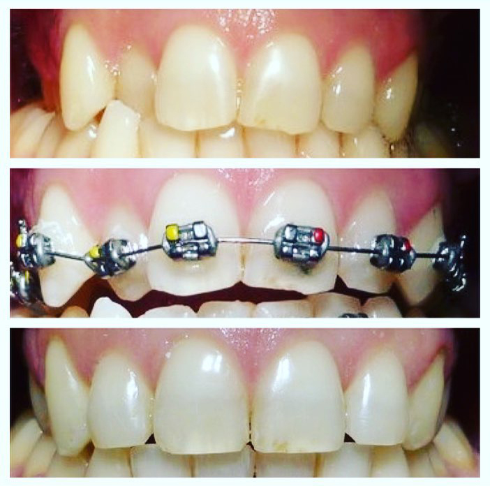orthodontics-tracey-bell-dental-braces