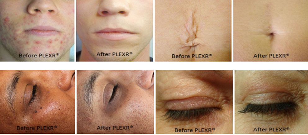 treatment keloid scars, acne treatment laser, nonsurgical eye lid lift